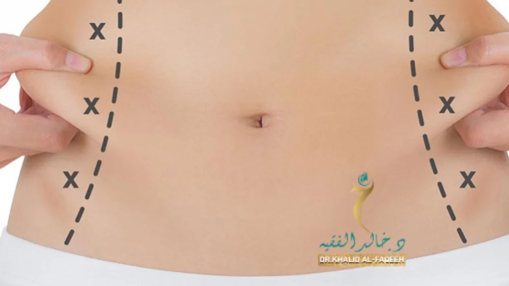تجارب شفط الدهون في الرياض