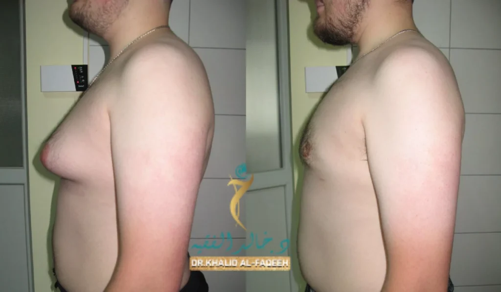 تجربتي مع عملية التثدي