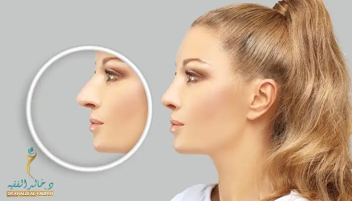 عملية تجميل الأنف بالتقسيط في الرياض