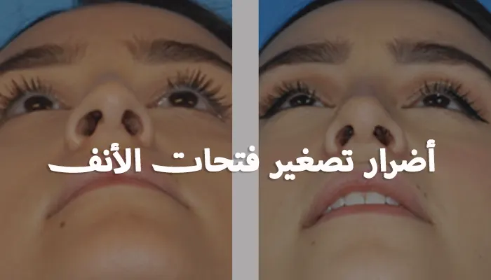 أضرار تصغير فتحات الأنف