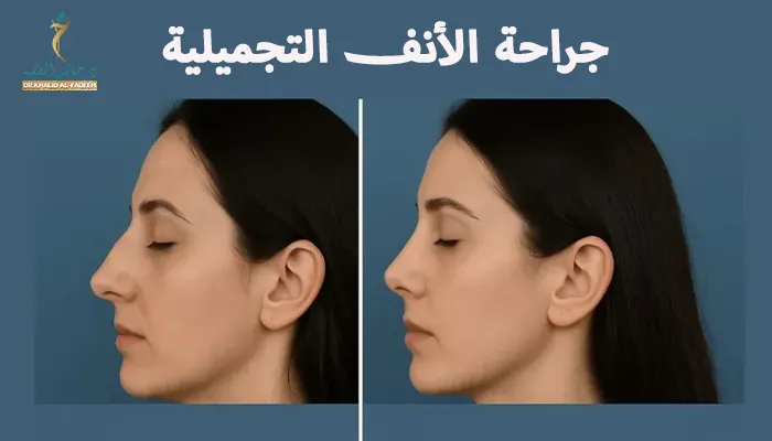 جراحة الأنف التجميلية