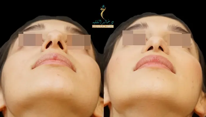 تصغير فتحات الأنف جراحياً