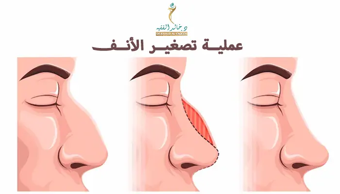 عملية تصغير الأنف