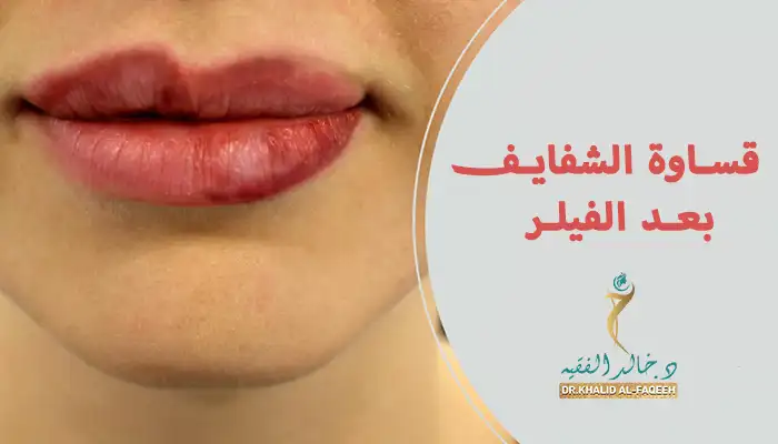 قساوة الشفايف بعد الفيلر