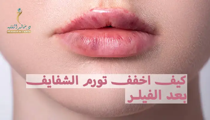 كيف اخفف تورم الشفايف بعد الفيلر