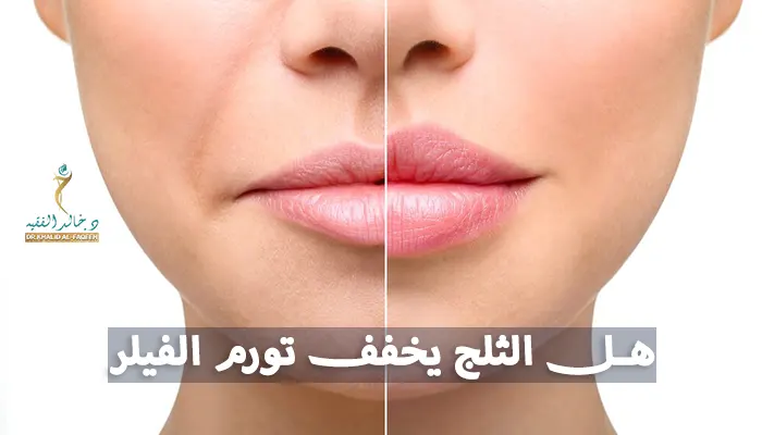 هل الثلج يخفف تورم الفيلر