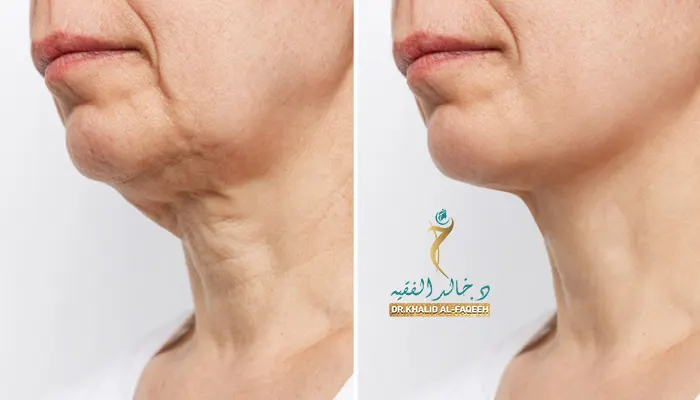 مدة التعافي بعد شد الرقبة: دليل رحلة التعافي الآمنة