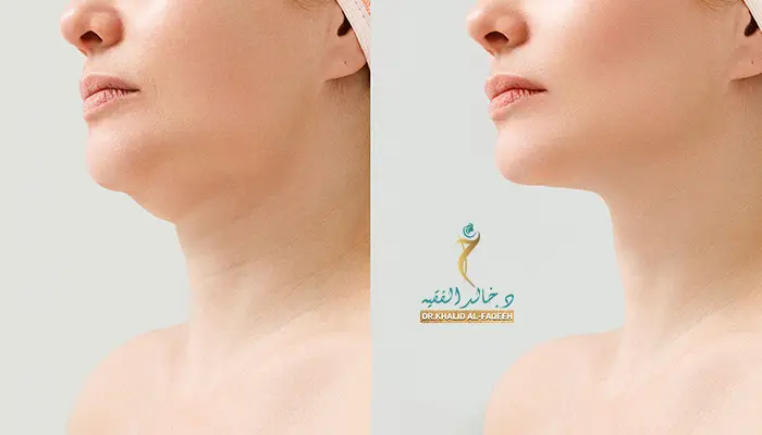 تجارب عملية شد الرقبة