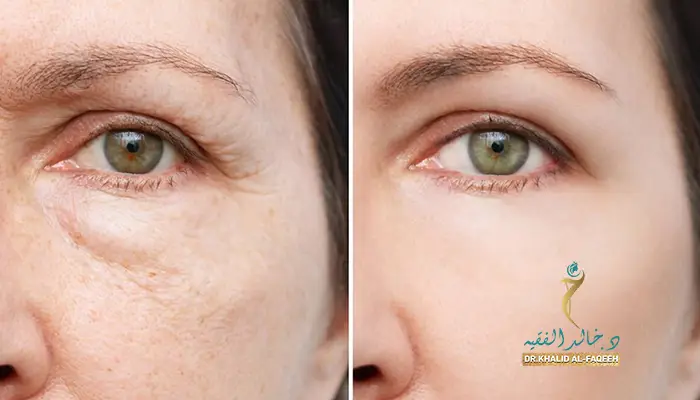 شد الوجه بالبوتوكس والفيلر: حلول سريعة للتجاعيد والخطوط الدقيقة