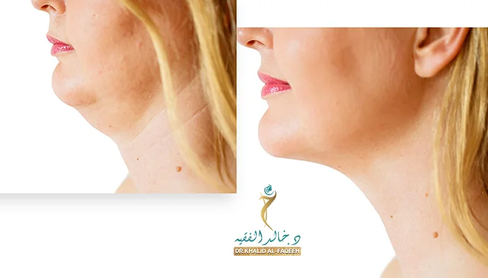 أفضل عيادة لعملية شد الوجه والرقبة بالرياض
